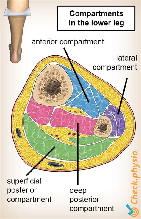 Compartment syndrome of the lower leg | Physio Check