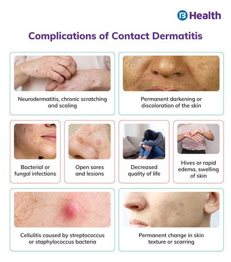 What causes contact dermatitis and how to treat it?