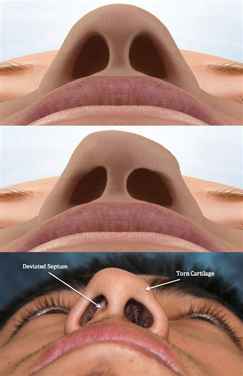 Nasal Fracture - Facial Trauma