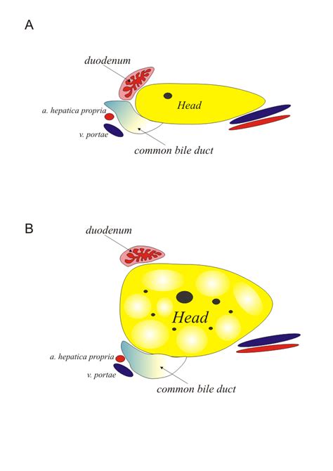 Is choledochoduodenostomy in the management of common bile duct stones ...