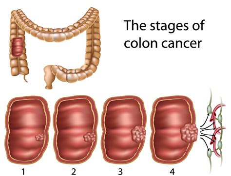 Prevention of Colon Polyps and Cancer | Jackson Siegelbaum Gastroenterology