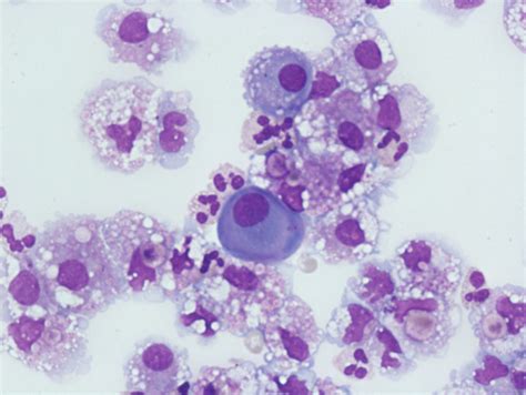 Peritoneal Fluid