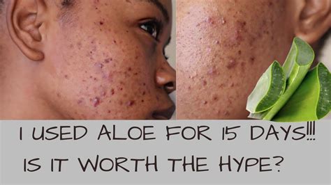 I USED ALOE VERA ON MY ACNE/ SCARS (SPOTS) FOR 15 DAYS & THIS HAPPENED ...