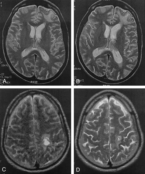 Brain Atrophy in Mild or Moderate Traumatic Brain Injury: A ...