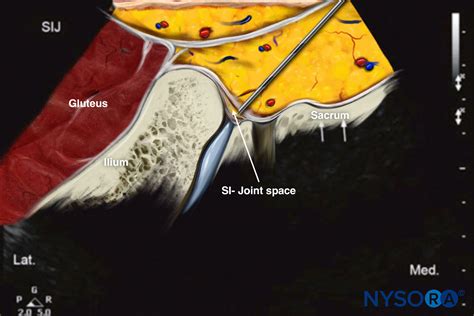 Inyección en la articulación sacroilíaca guiada por ultrasonido - NYSORA