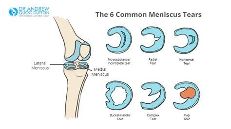 Meniscus Tears Occurence In Singapore