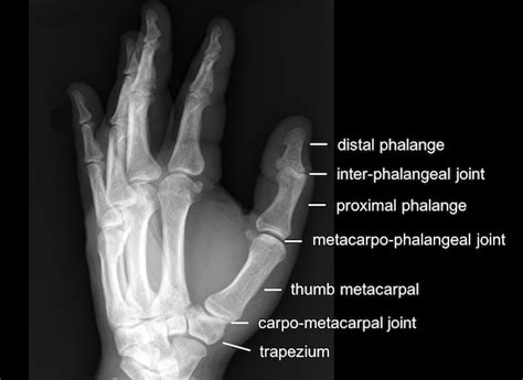 Thumb fracture