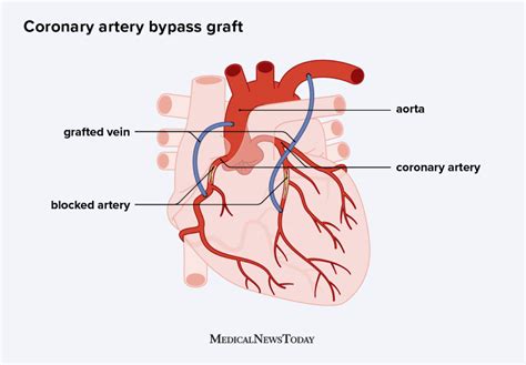 Heart bypass surgery: Procedure, recovery time, and risks