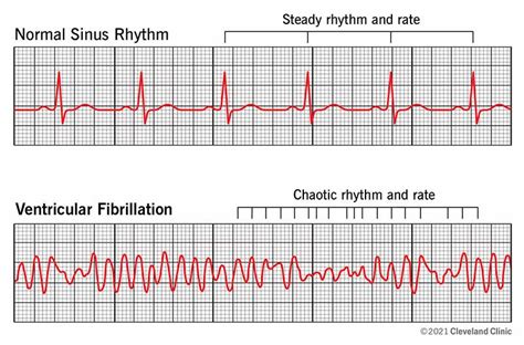 Ventricular Tachycardia Ecg