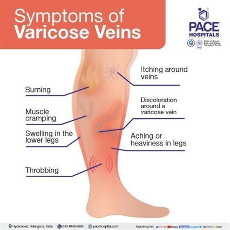 Varicose Veins – Symptoms, Causes, Complications and Treatment