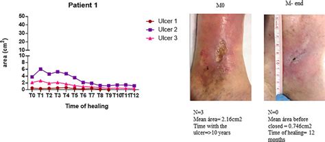 Patient 1 before and after PRP treatment. Patient's wound progress ...