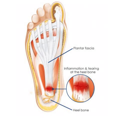 What is Plantar Fasciitis? Do you have Heel pain? | Body Works Sports ...