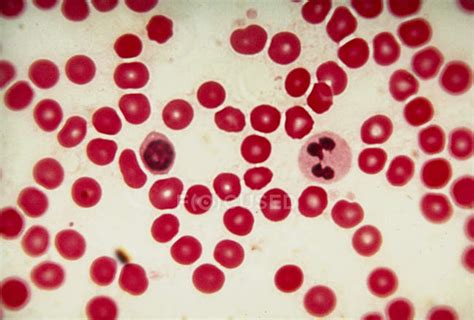 Light micrograph of human red blood cells (erythrocytes), with two ...