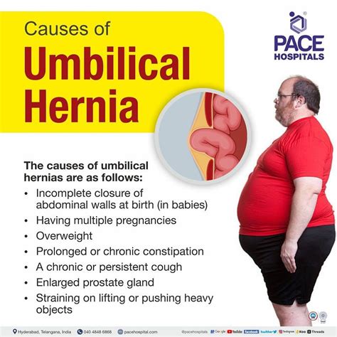 Umbilical hernia - Symptoms, Causes, Complications and Prevention