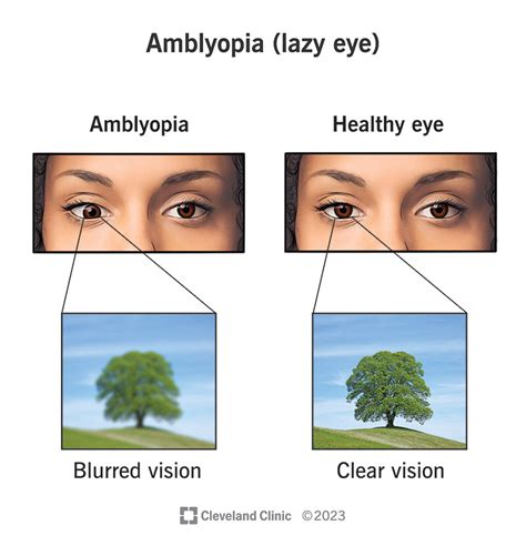 Lazy Eye (Amblyopia): Symptoms, Causes & Treatment