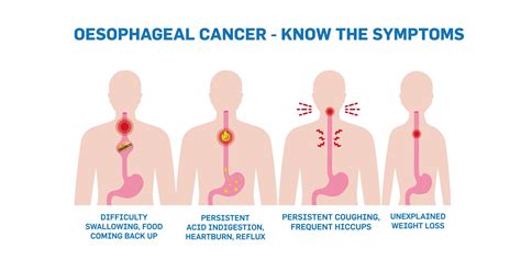 Esophageal Cancer Symptoms, Causes, Complications, 44% OFF