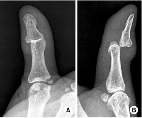 Thumb Proximal Phalanx Fracture