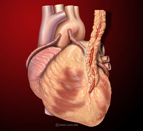 Saphenous vein graft - wikidoc