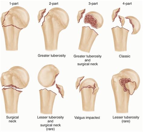 Open Reduction and Internal Fixation of Proximal Humerus Fractures ...