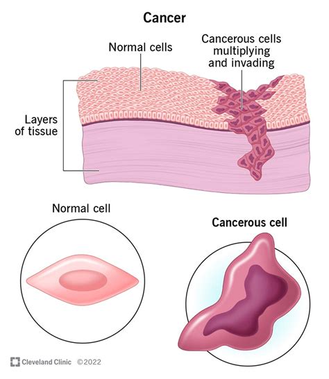 50 Shocking Statistics: Global Cancer Prevalence Unveiled - 2024