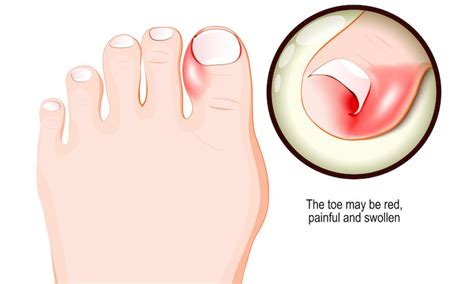 INGROWN TOENAIL TREATMENT - Foot HQ