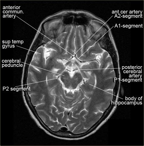 Anatomy Of Brain Ct Scan Anatomy Drawing Diagram | Images and Photos finder