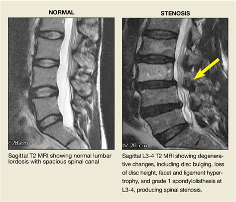 Mri Lumbar Spine Anatomy | The Best Porn Website