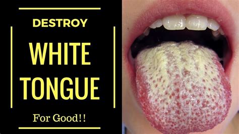 What Causes White Tongue and Are There Any Treatments For White Tongue ...