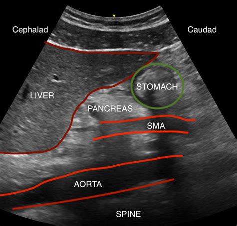 [Figure, Gastric ultrasound anatomy, including liver,...] - StatPearls ...