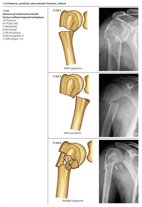 Mechanisms Of Humeral Head Fracture