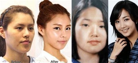 Amazing transformation after their plastic surgery will blow your mind