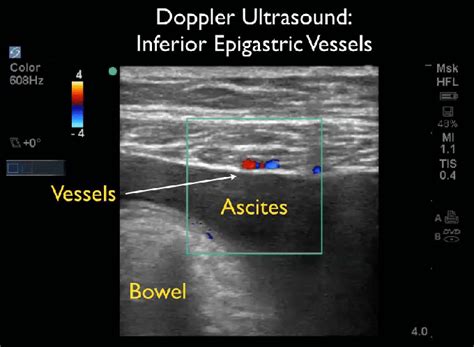 Inferior epigastric vessels with color doppler. | Download Scientific ...