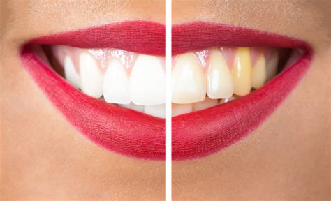 Get Your Smile Glowing For Summer With These Expert Tips!