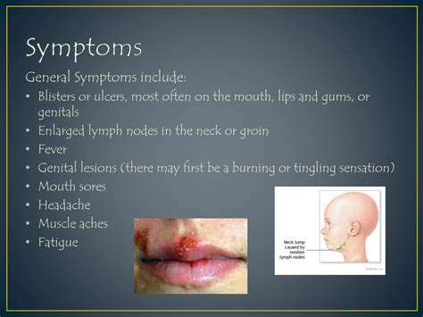 PPT - Herpes Simplex Virus PowerPoint Presentation, free download - ID ...