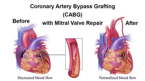 Coronary Artery Bypass Grafting with Mitral Valve Repair by Dr Yugal K ...