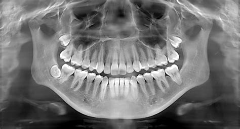 Digital Dental X-Rays - Tuan Pham DDS