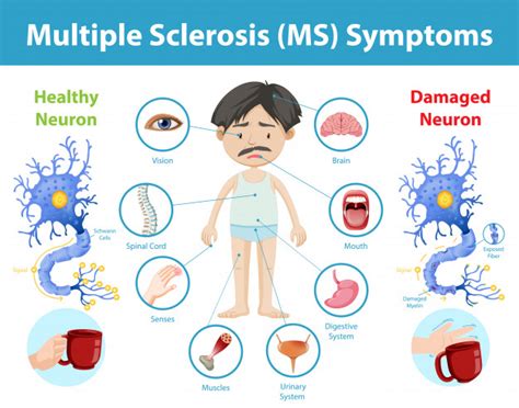 How does Multiple Sclerosis affect the Brain, Spinal cord, and Immune ...