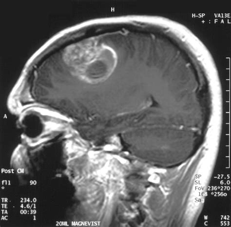 Brain Tumors: How Surgeons are Operating on the Inoperable