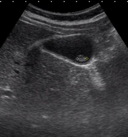 Gallbladder polyp | Radiology Reference Article | Radiopaedia.org