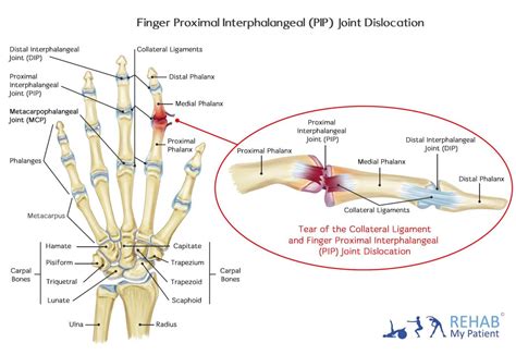 Finger Proximal Interphalangeal (PIP) Joint Dislocation | Rehab My Patient