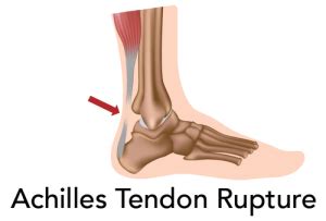 Achilles Tendon Repair Rehab Protocol & Recovery Time Frame