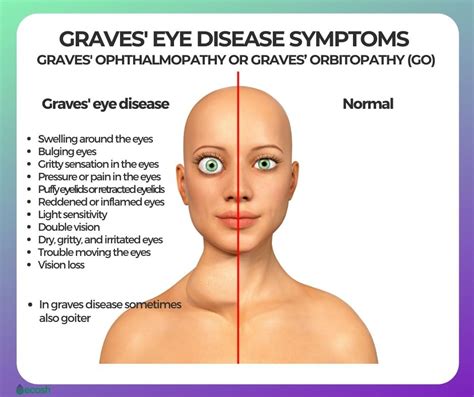 Can CBD Help Treat Graves' Disease? - Smart CBD Hub