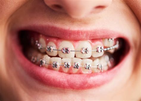 FAKE BRACES ARE RUINING KIDS’ TEETH - 96.9 KAYO