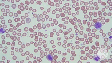 Myelofibrosis