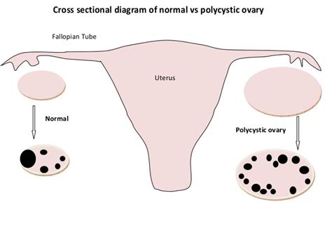 Normal Vs Polycystic Ovaries Ultrasound