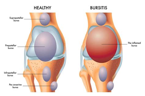 Bursitis: Treatment, Symptoms & Causes | The Feet People Podiatry