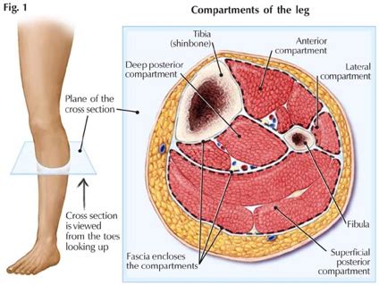 COSM | Fasciotomy / fasciectomy for chronic exertional compartment syndrome