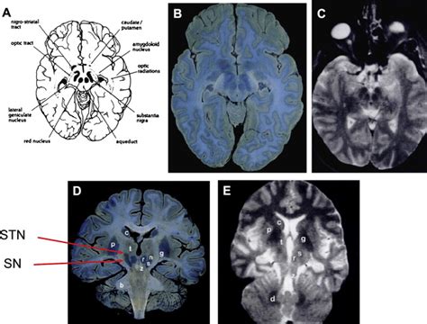 Anatomy of the Substantia Nigra and Subthalamic Nucleus on MR Imaging ...