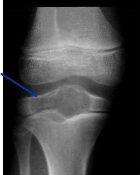 Chondroblastoma Gross