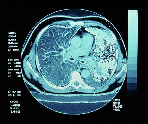 Ct Scan On Chest Showing Lung Cancer Photograph by Simon Fraser/science ...